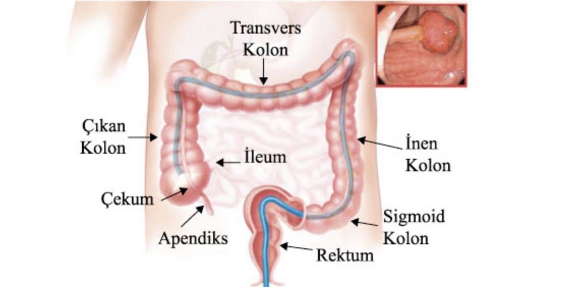 kalin bagirsak kanserinde poliplerin onemi 0 sAfGdJfI
